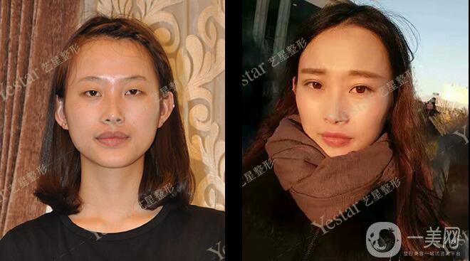 *前后 *手術(shù)*果如何？