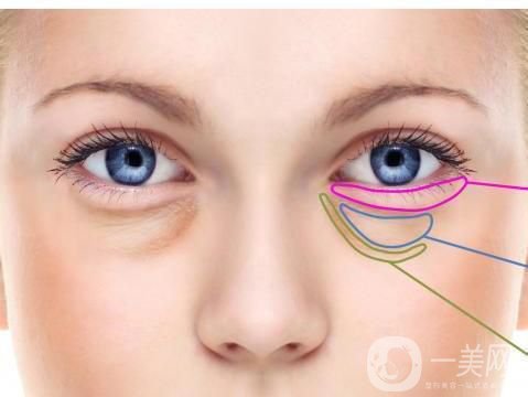 深圳去眼袋手術(shù)多少錢 去眼袋有什么風(fēng)險嗎？