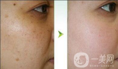 紅寶石激光祛斑*果,紅寶石激光祛斑術(shù)后注意事項(xiàng)