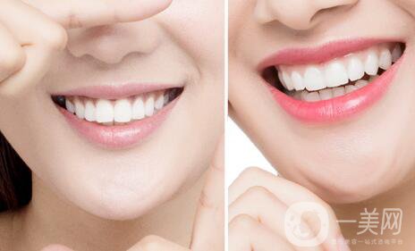 哪種烤瓷牙比較好？他們有什么區(qū)別呢？