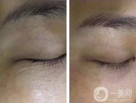 醫(yī)院調(diào)節(jié)魚尾紋案例