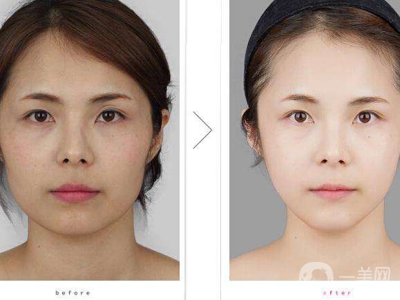 光子嫩膚做一次多少錢 光子嫩膚可以除皺嗎