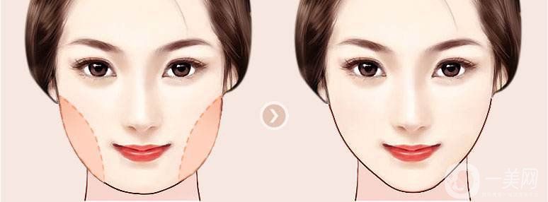 面部吸脂減肥價格 面部吸脂多久消腫