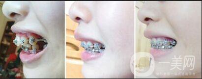 天包地牙齒矯正,天包地牙齒矯正手術(shù)方法