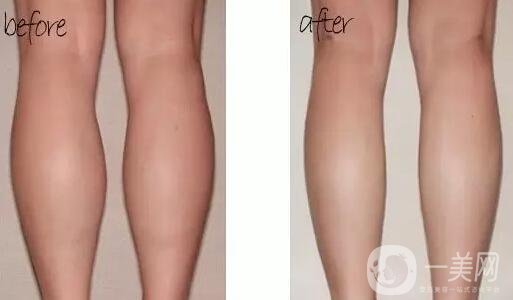 **多少錢 有副作用嗎 需要注射幾次？