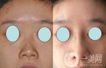 朝天鼻矯正多久能恢復(fù) 朝天鼻矯正前后