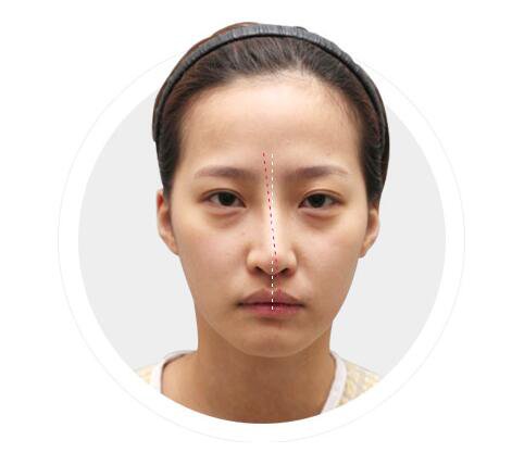 北京鼻骨矯正術(shù)多少錢 鼻骨矯正會留疤痕嗎