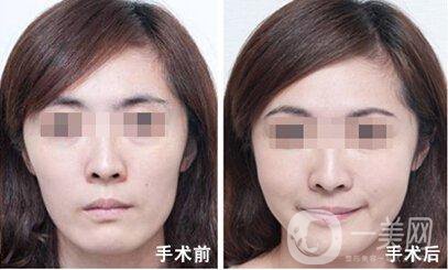 臉頰隆起的原因是什么 手術怎么做？