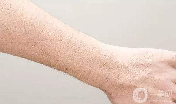 激光脫毛怎么樣 激光脫毛的工作原理