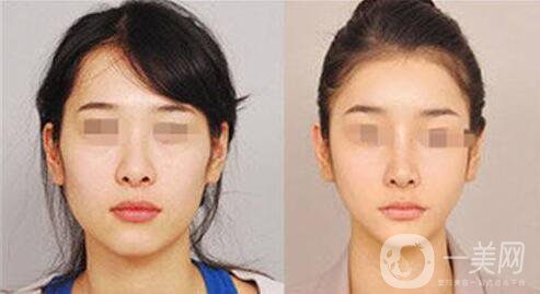 下頜整形手術(shù)的方法有哪些？