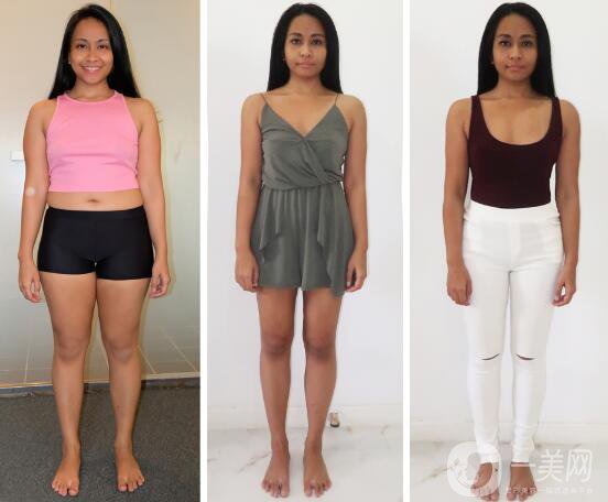 你真的適合吸脂手術(shù)嗎？吸脂適應(yīng)癥介紹