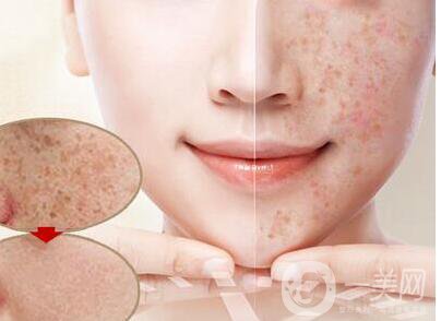 激光去曬斑多久恢復(fù),激光去曬斑術(shù)后護理