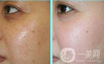 激光去曬斑多久恢復(fù),激光去曬斑術(shù)后護理