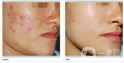 果酸祛痘副作用,果酸祛痘后遺癥