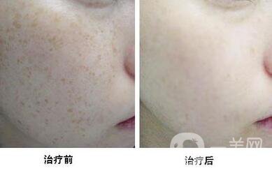 激光去曬斑價(jià)格,激光去曬斑*果