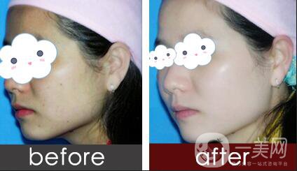 激光光子嫩膚價(jià)格,光子嫩膚*果