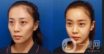 自體脂肪面部填充價(jià)格