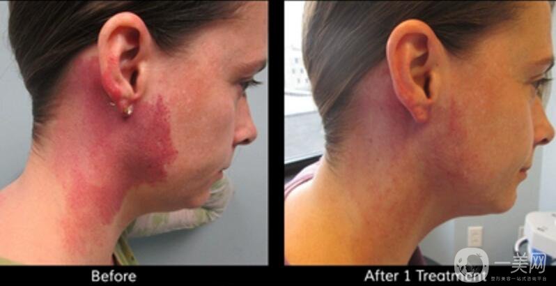 去紅色胎記留疤嗎？有哪些方法可以去胎記呢？