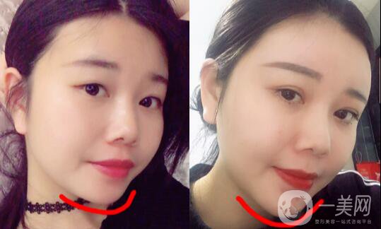 自體脂肪墊下巴恢復(fù)期是怎樣的？如何做好術(shù)后護(hù)理？