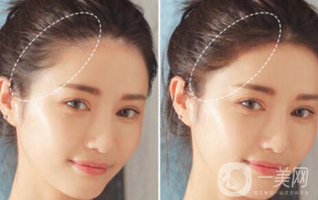 半*發(fā)際線的弊端有哪些？