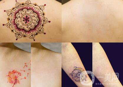 什么是激光去除紋身？洗紋身疼不疼？