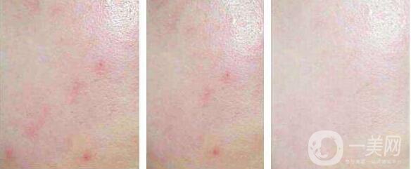 微針去痘坑*果怎樣 微針去痘坑好不好