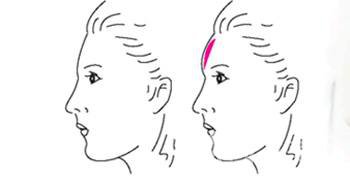 假體豐額頭價(jià)格 膨體和硅膠信息介紹