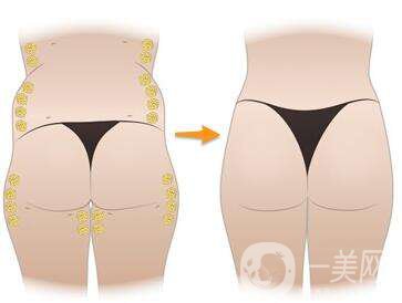 假體豐臀注意事項(xiàng) 假體豐臀飲食禁忌