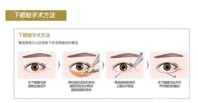 沃斯堡眼瞼手術(shù)怎么樣 有風(fēng)險(xiǎn)嗎？