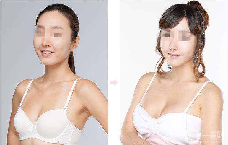 乳房提升怎么樣 隆胸手術(shù)時間是多久
