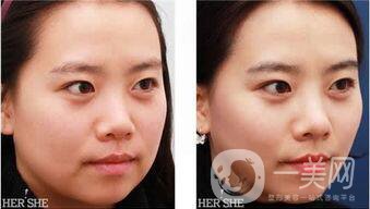 廣州做面部提升術(shù)*果