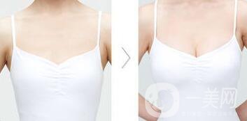 隆胸注意事項(xiàng)