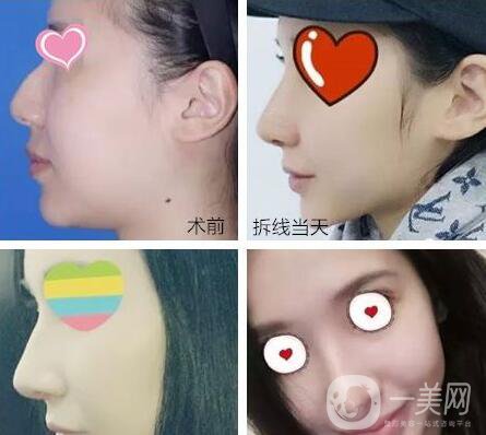 上海九院戴傳昌,上海九院戴傳昌做鼻子,上海九院李青峰