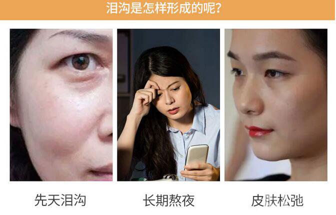 膠原蛋白填淚溝恢復(fù)期是多久呢 術(shù)后護(hù)理要注意什么？