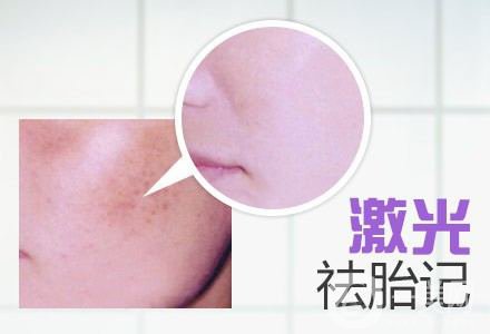 激光去胎記的恢復(fù)過程 激光去胎記的方法