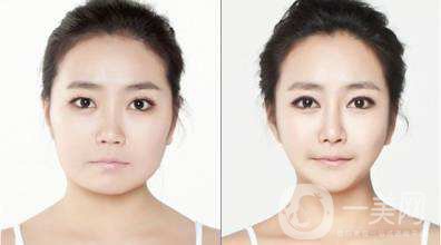 磨骨手術(shù)照片 磨骨手術(shù)好不好