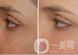 *去魚尾紋怎么樣 去魚尾紋的方法