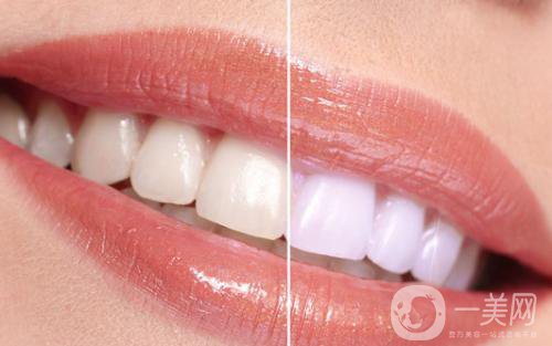 冷光美白牙齒的價(jià)格 冷光美白牙齒持久嗎