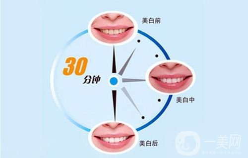 冷光美白牙齒的價(jià)格 冷光美白牙齒持久嗎