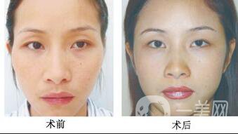 自體脂肪豐太陽穴,自體脂肪豐太陽穴多少錢