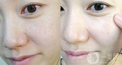 祛斑價格,祛斑貴不貴