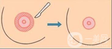 乳頭漂紅價(jià)格,乳頭漂紅多少錢