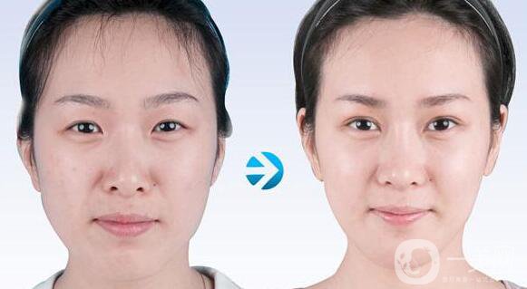 豐太陽穴多少錢,豐太陽穴價(jià)格