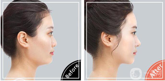 鼻頭縮小手術(shù)圖,鼻頭縮小術(shù)后護(hù)理