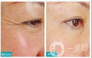 *多少錢一針,*價格