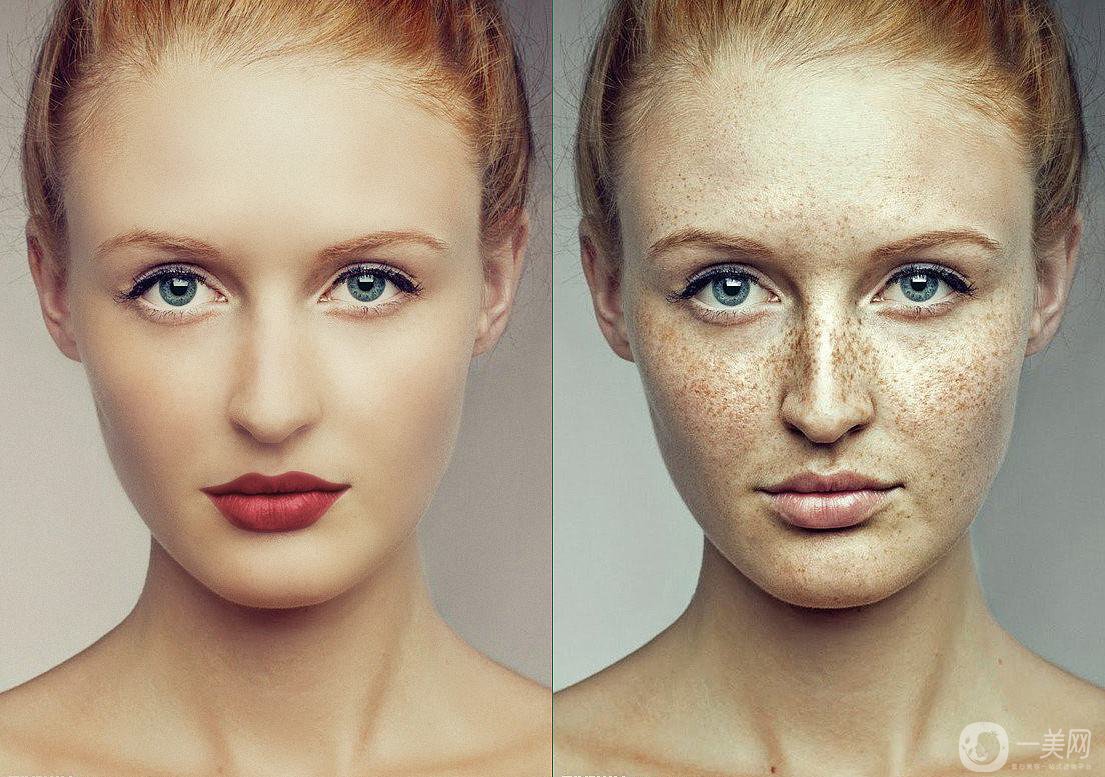 祛斑價格是多少 祛斑的方法有哪些