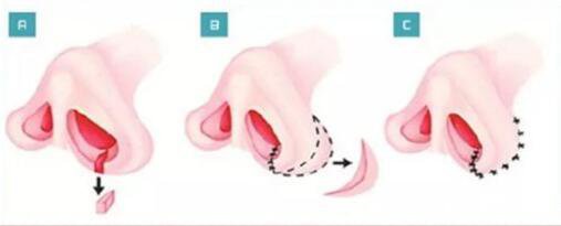 鼻翼縮小整形價(jià)格 鼻翼縮小多久恢復(fù)
