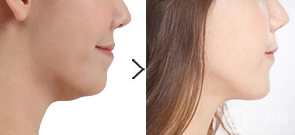 下巴增強(qiáng)有風(fēng)險(xiǎn)嗎 手術(shù)要多久時(shí)間？