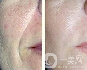 熱瑪吉除皺*果,熱瑪吉除皺風(fēng)險(xiǎn)