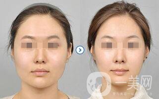 下頜角截骨貴嗎,下頜角截骨價(jià)格